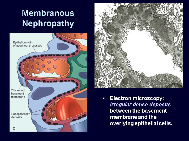 Membranous Nephropathy Electron microscopy: irregular dense deposits between the basement membrane and the overlying